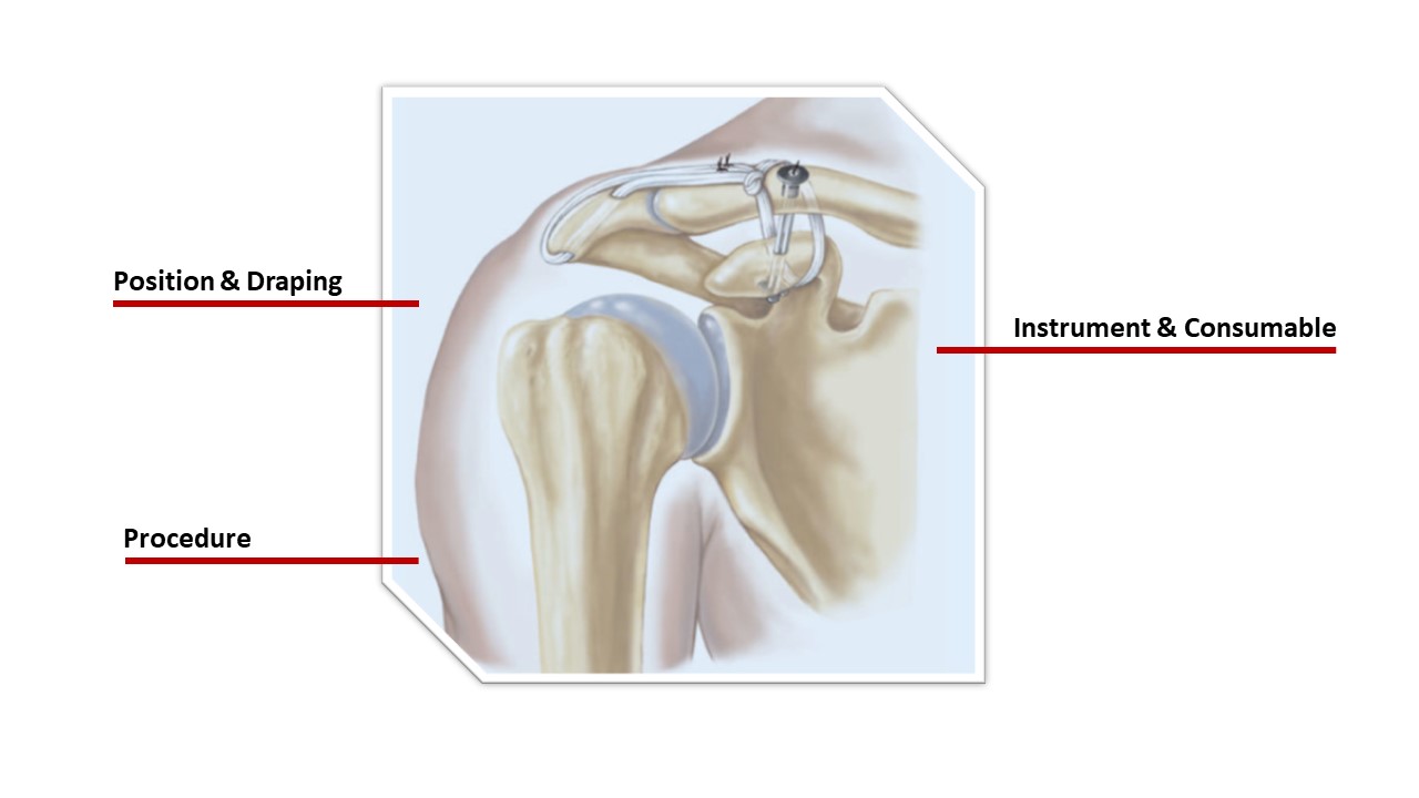 Arthroscopic assisted reduction of AC joint