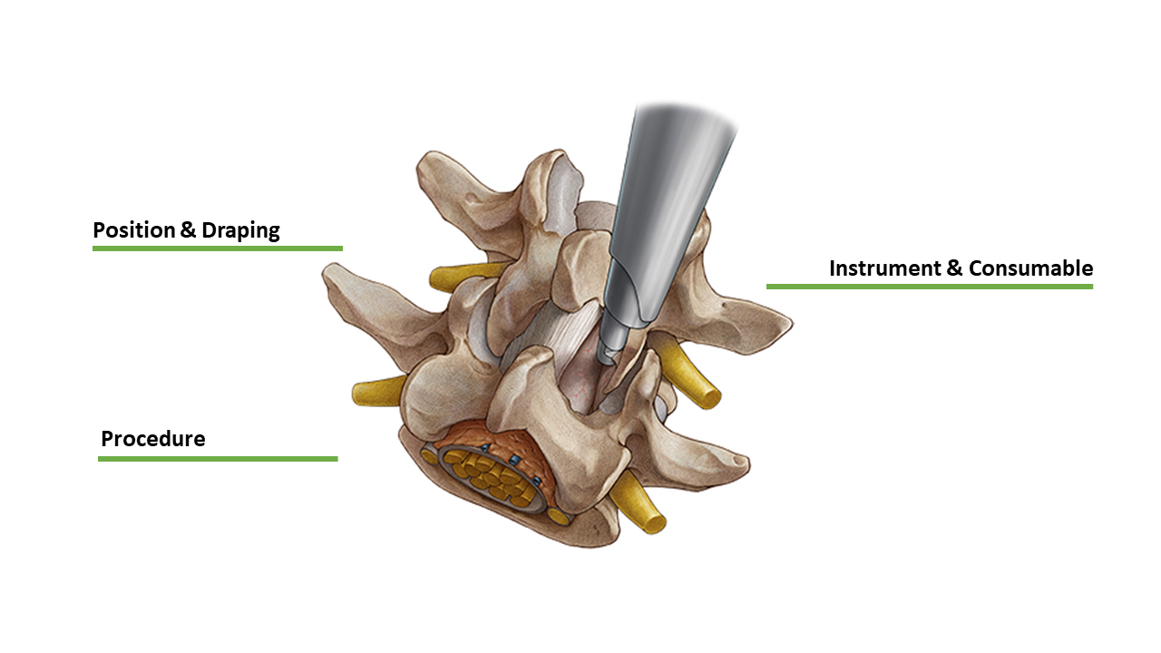 Endoscopic Radiofrequency Facet Medical Branch Ablation