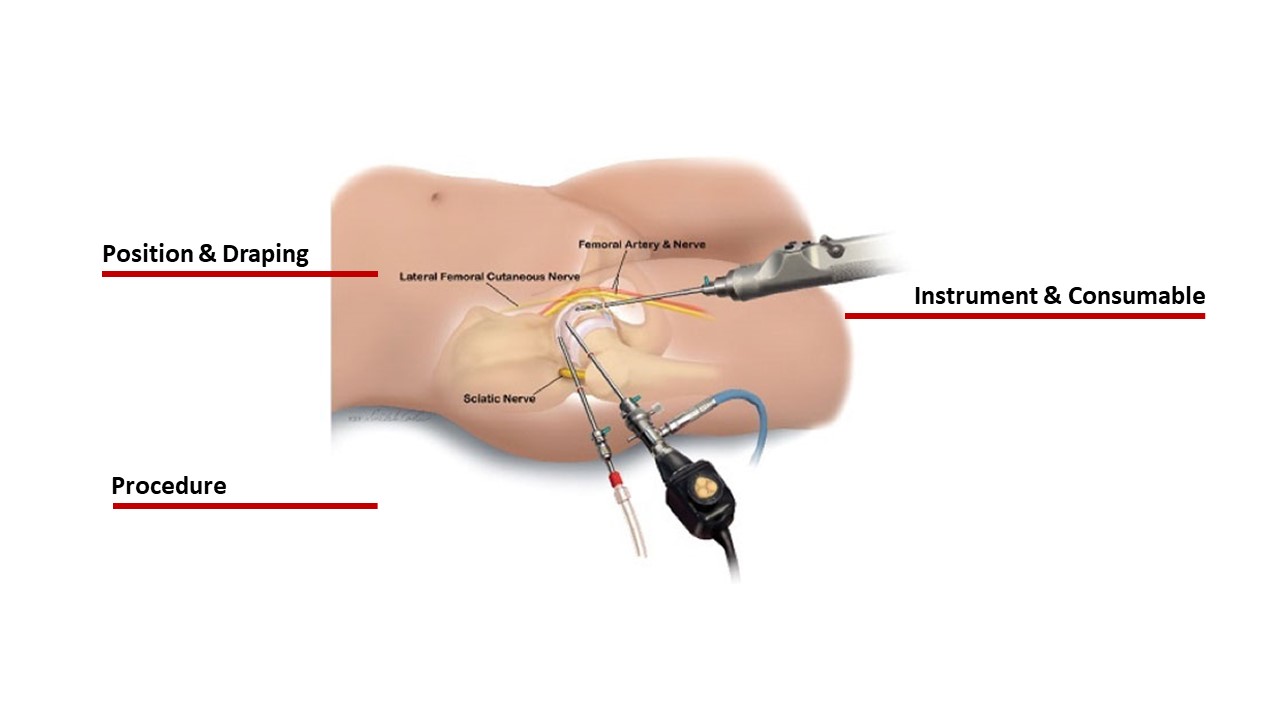 Hip Arthroscopy