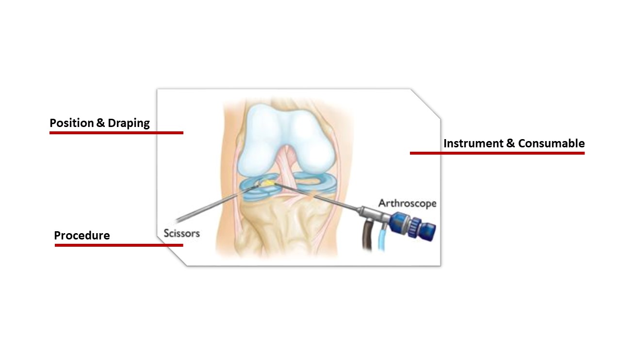 Knee arthroscopy