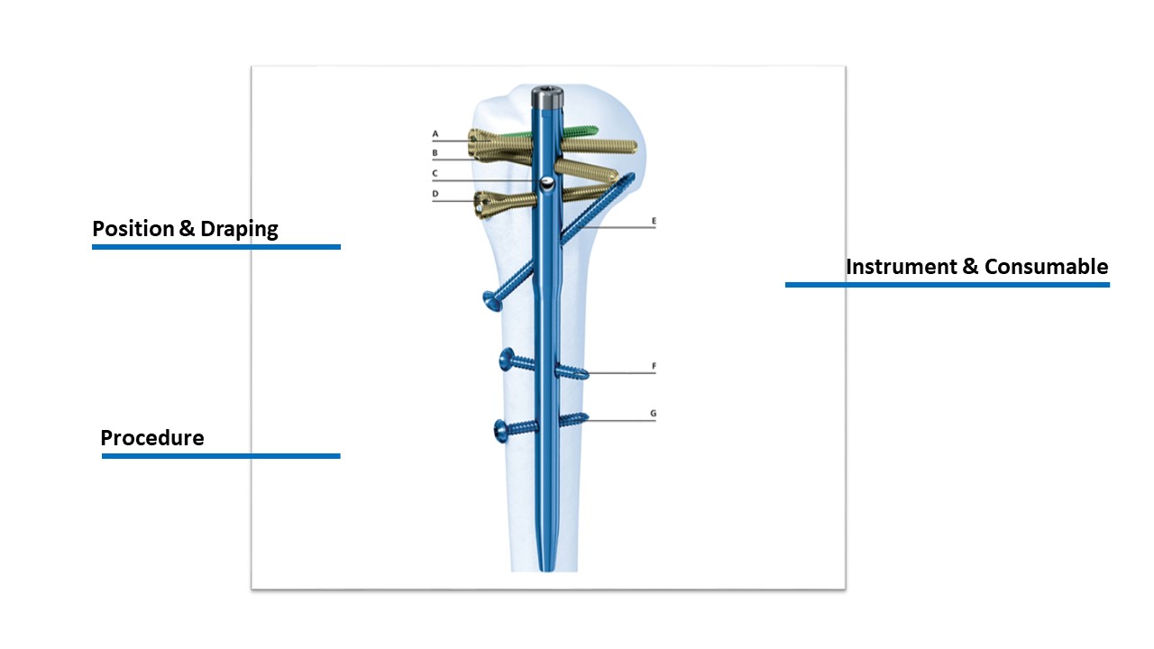 Humeral Nailing