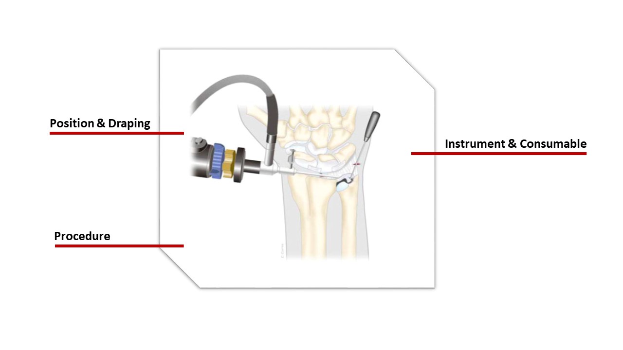 Wrist Arthroscopy