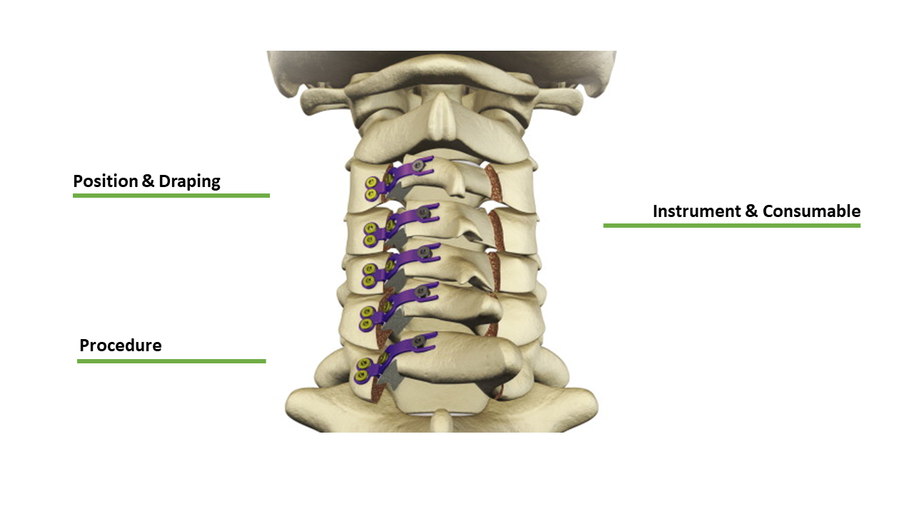 Cervical Laminoplasty (plate)