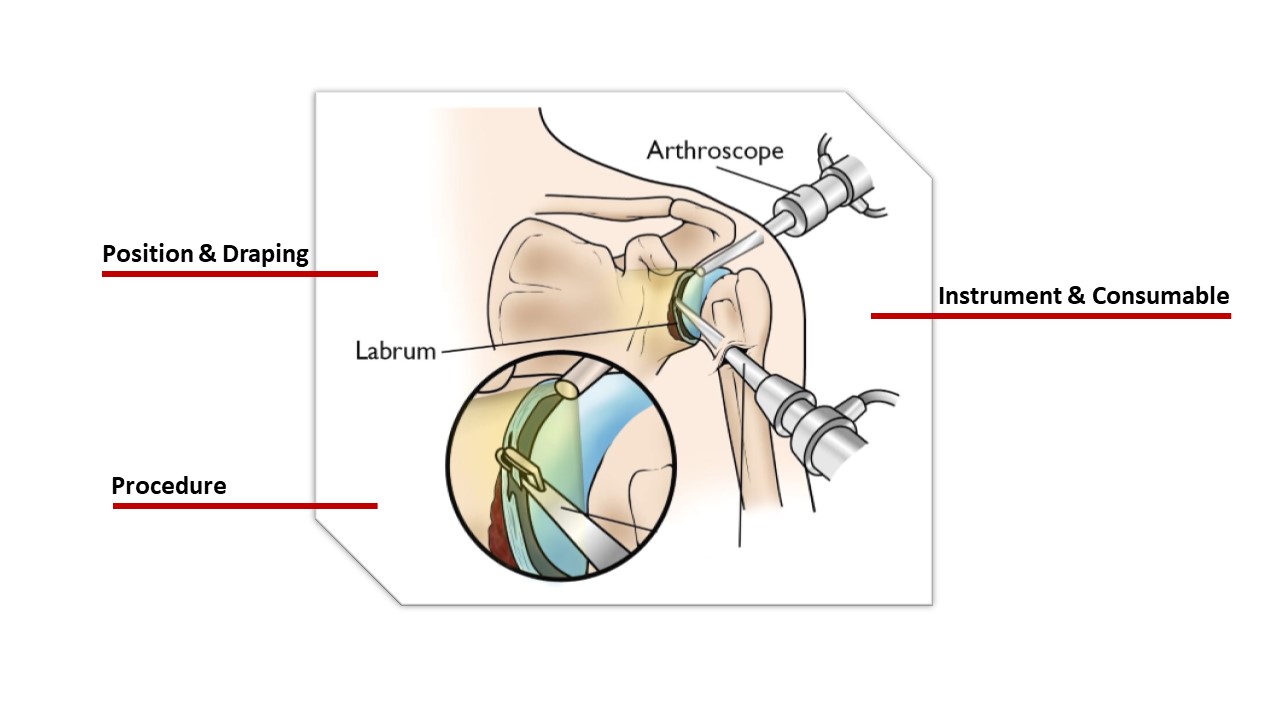 Shoulder Arthroscopy